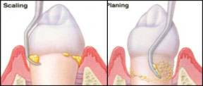Scaling & Root Planing illustration